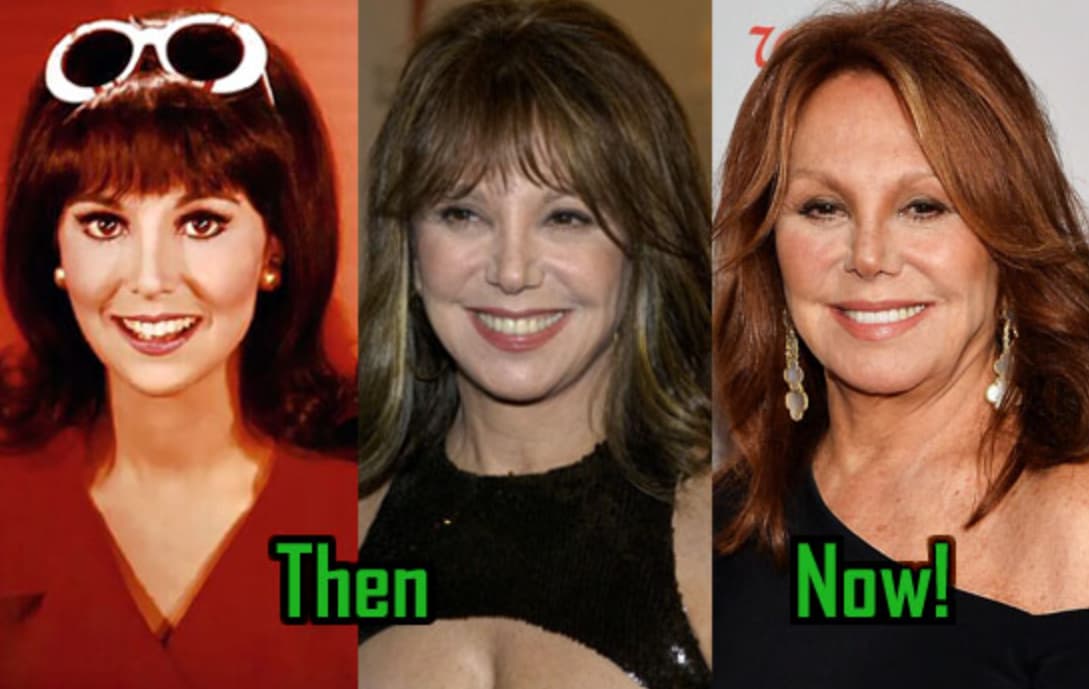 Marlo Thomas Plastic Surgery Before & After Pictures